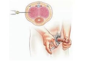 injecteerbare penisvergroting