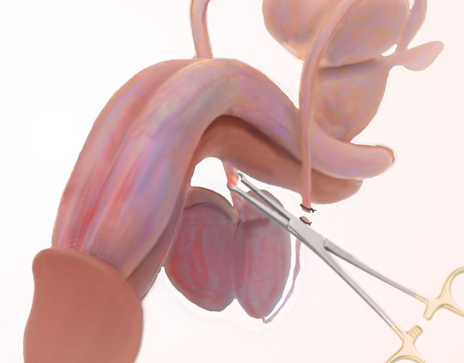 ligamentotomie voor penisvergroting