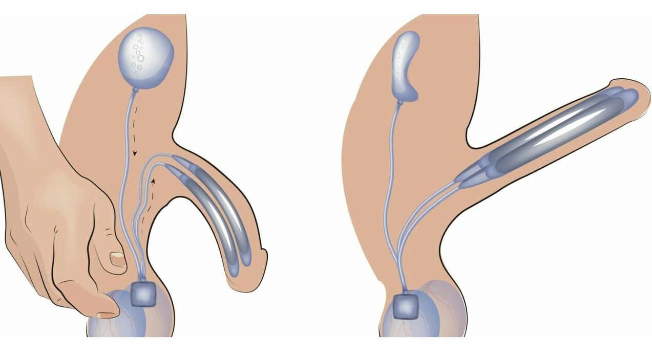 penisprothese voor penisvergroting