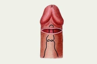 het vergroten van de penis